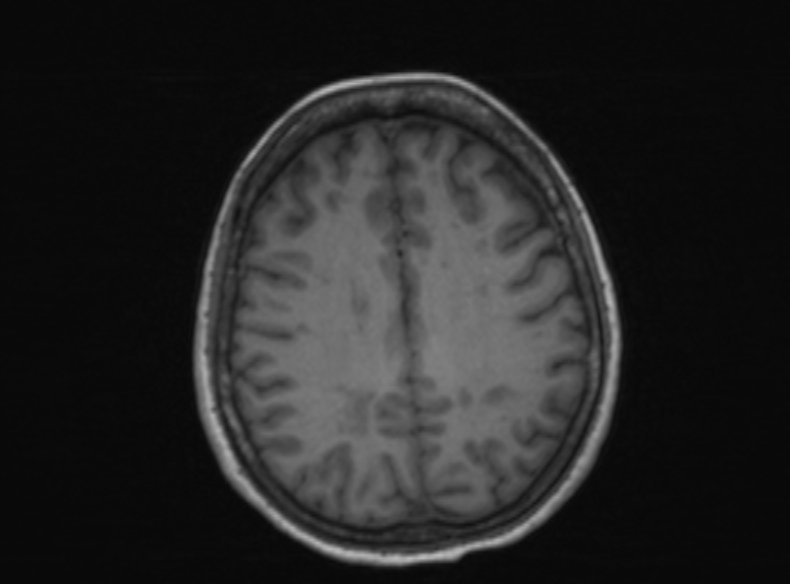 Bilateral PCA territory infarction - different ages (Radiopaedia 46200-51784 Axial T1 191).jpg