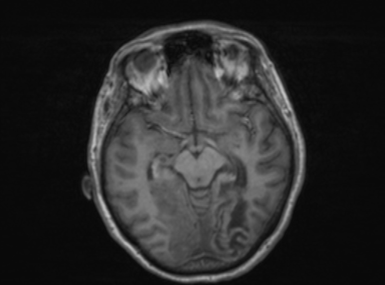 File:Bilateral PCA territory infarction - different ages (Radiopaedia 46200-51784 Axial T1 261).jpg