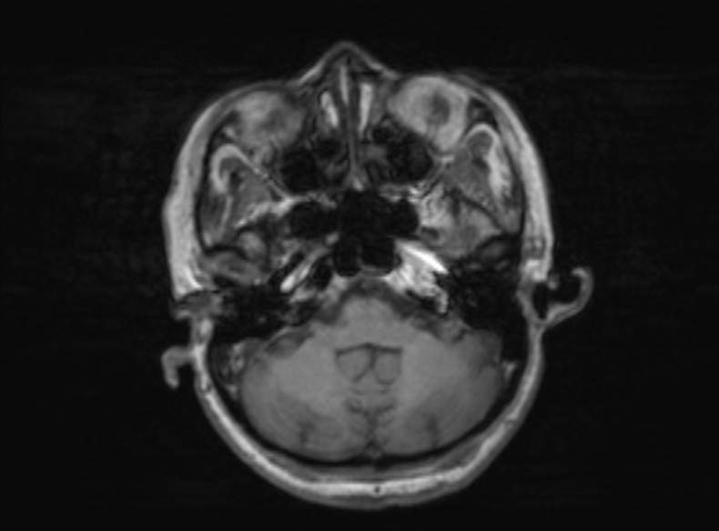 Bilateral PCA territory infarction - different ages (Radiopaedia 46200-51784 Axial T1 312).jpg