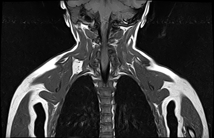 File:Bilateral Sprengel deformity with Klippel-Feil syndrome (Radiopaedia 66395-75650 Coronal T1 16).jpg