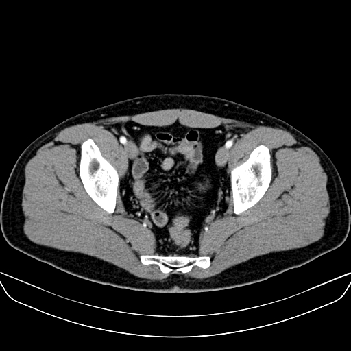 File:Bilateral accessory renal arteries with mild pelvi-ureteric junction (PUJ) obstruction (Radiopaedia 66357-75596 A 64).jpg