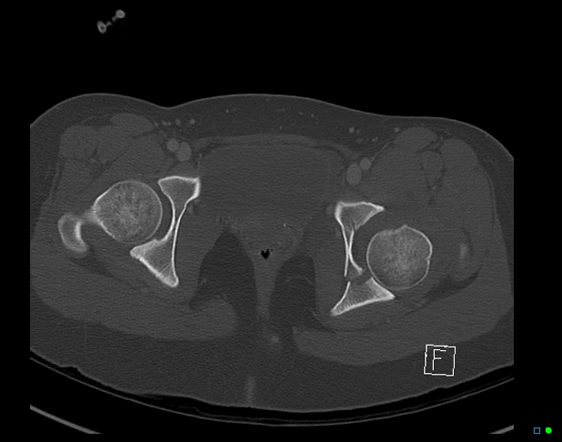 Bilateral acetabular fractures (Radiopaedia 79272-92308 Axial bone window 49).jpg