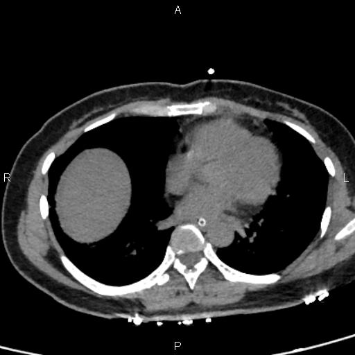 Bilateral adrenal gland hyperenhancement in pancreatitis (Radiopaedia 86642-102753 Axial non-contrast 1).jpg