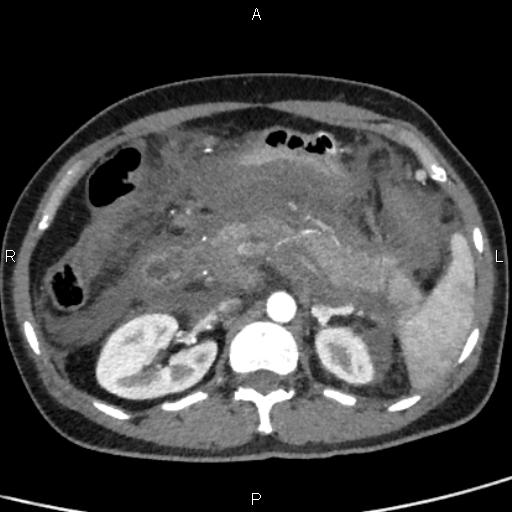 Bilateral adrenal gland hyperenhancement in pancreatitis (Radiopaedia 86642-102753 B 49).jpg
