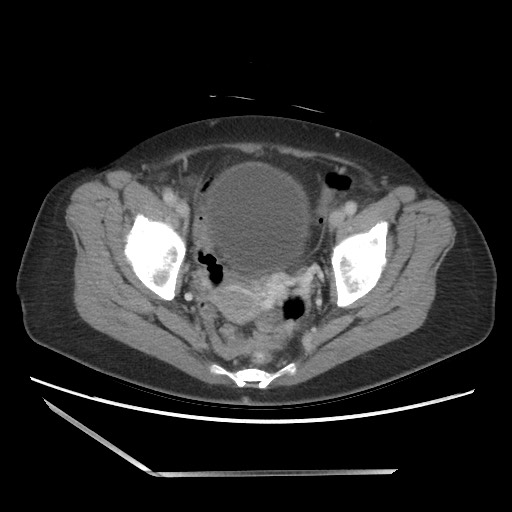Bilateral adrenal granulocytic sarcomas (chloromas) (Radiopaedia 78375-91007 A 104).jpg