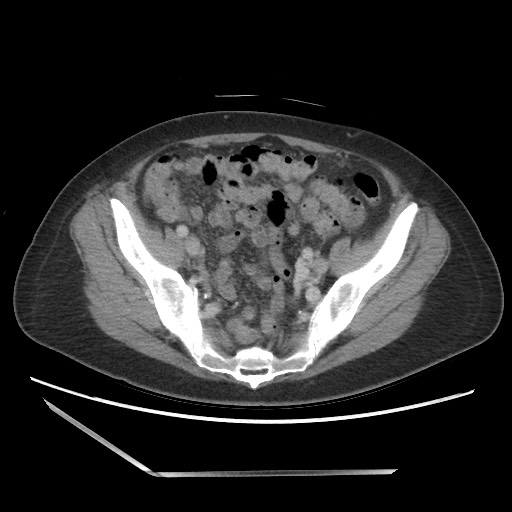 File:Bilateral adrenal granulocytic sarcomas (chloromas) (Radiopaedia 78375-91007 A 93).jpg