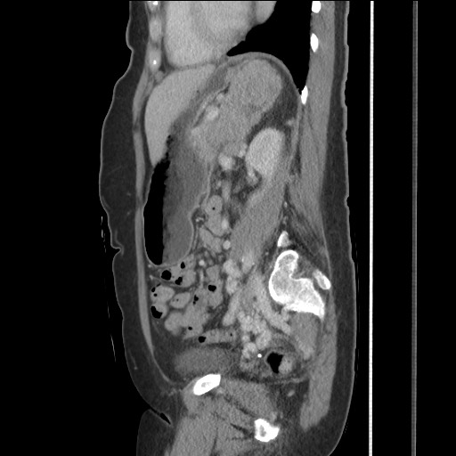 File:Bilateral adrenal granulocytic sarcomas (chloromas) (Radiopaedia 78375-91007 C 89).jpg