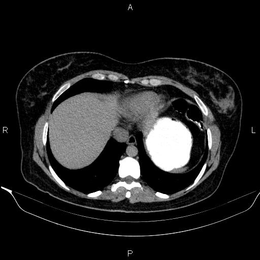 File:Bilateral adrenal myelolipoma (Radiopaedia 63058-71535 Axial non-contrast 13).jpg