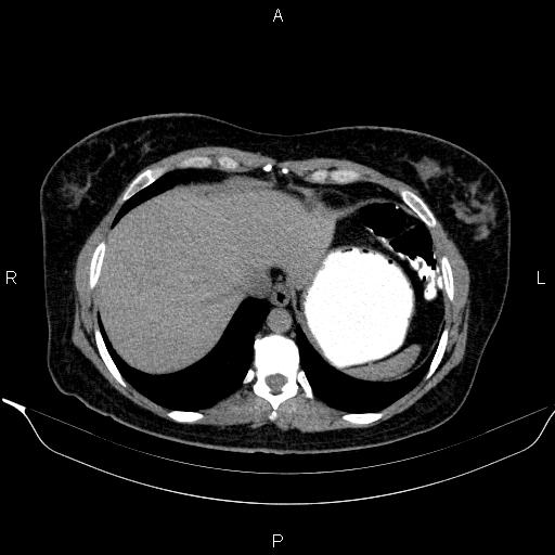 File:Bilateral adrenal myelolipoma (Radiopaedia 63058-71535 Axial non-contrast 17).jpg
