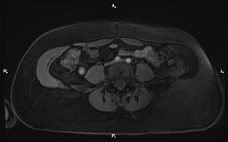 File:Bilateral adrenal myelolipoma (Radiopaedia 63058-71537 Axial T1 C+ fat sat 76).jpg