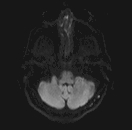 File:Bilateral and symmetric thalamic glioma (Radiopaedia 66119-75289 Axial DWI 4).jpg