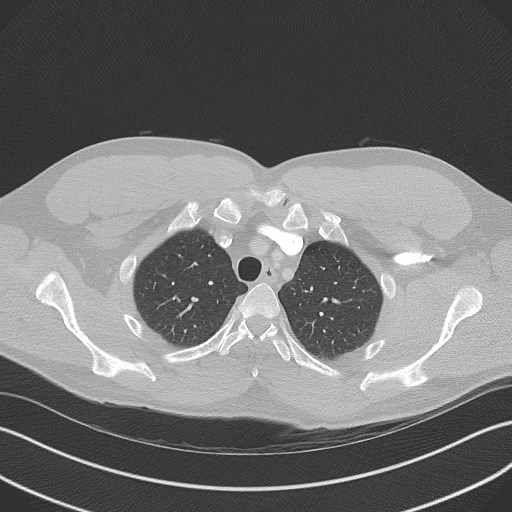 Bilateral atelectasis (Radiopaedia 48666-53675 Axial lung window 18).jpg