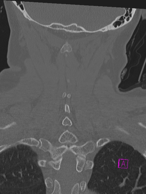 Bilateral atlanto-occipital assimilation (Radiopaedia 28350-28603 Coronal bone window 38).jpg