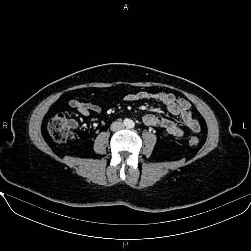 Bilateral benign adrenal adenomas (Radiopaedia 86912-103124 B 64).jpg