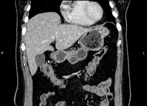 Bilateral benign adrenal adenomas (Radiopaedia 86912-103124 D 14).jpg