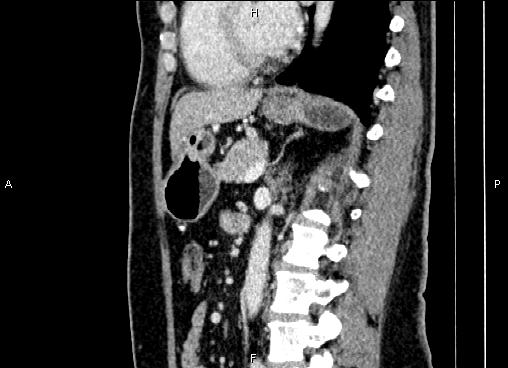 Bilateral benign adrenal adenomas (Radiopaedia 86912-103124 E 58).jpg