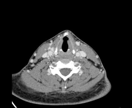 Bilateral carotid body tumors (Radiopaedia 61841-69870 Axial Post contrast 75).jpg
