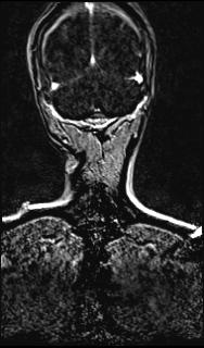 Bilateral carotid body tumors and right glomus jugulare tumor (Radiopaedia 20024-20060 MRA 143).jpg
