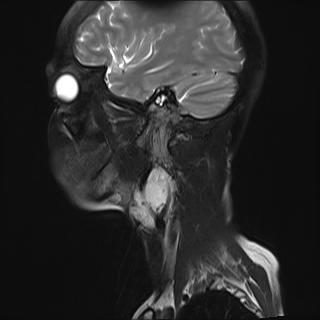 File:Bilateral carotid body tumors and right jugular paraganglioma (Radiopaedia 20024-20060 Sagittal 22).jpg
