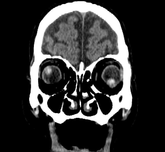 Bilateral ectopia lentis (Radiopaedia 89889-107013 Coronal non-contrast 46).jpg