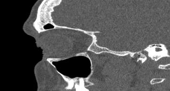 File:Bilateral ectopic infraorbital nerves (Radiopaedia 49006-54084 Sagittal 36).png
