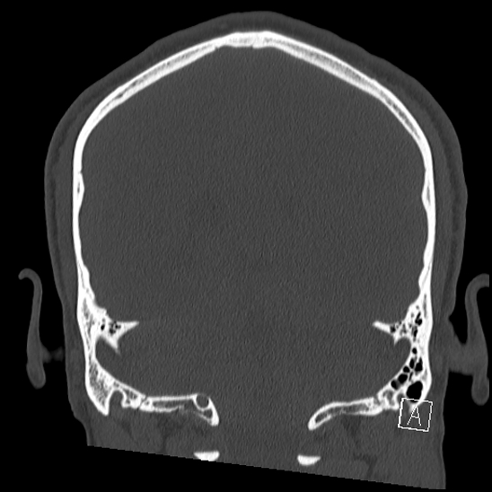 Bilateral occipital condyle fracture (type 2) (Radiopaedia 87675-104089 Coronal bone window 95).jpg