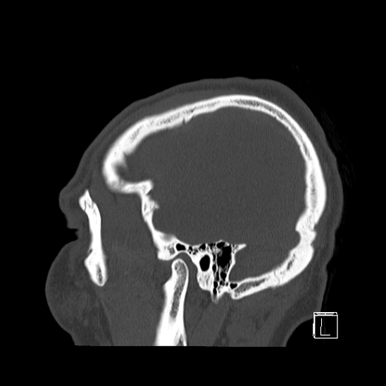 Bilateral occipital condyle fracture (type 2) (Radiopaedia 87675-104089 Sagittal bone window 101).jpg