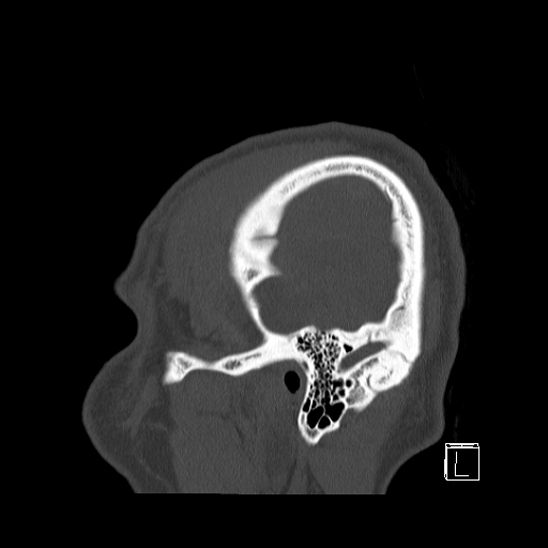 Bilateral occipital condyle fracture (type 2) (Radiopaedia 87675-104089 Sagittal bone window 109).jpg