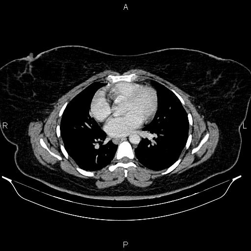 File:Bilateral ovarian dermoid cysts (Radiopaedia 85785-101603 A 1).jpg