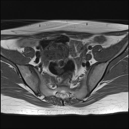 File:Bilateral ovarian endometriomas (Radiopaedia 87085-103347 Axial T1 6).jpg