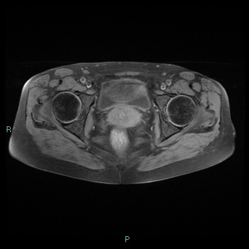 File:Bilateral ovarian fibroma (Radiopaedia 44568-48293 Axial T1 fat sat 21).jpg