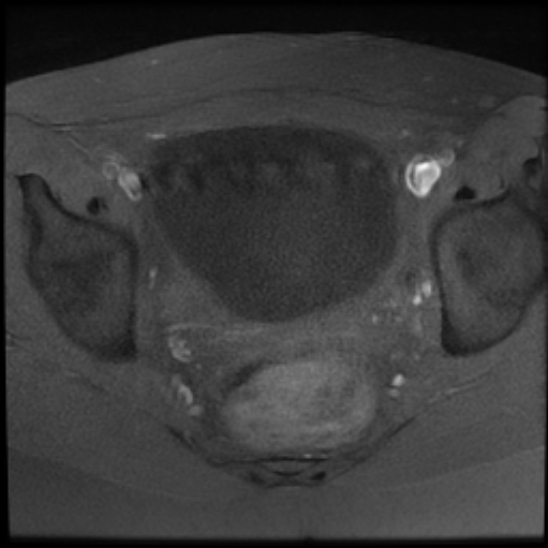 File:Bilateral ovarian fibrothecomas - adolescent (Radiopaedia 86604-102707 Axial T1 fat sat 19).jpg