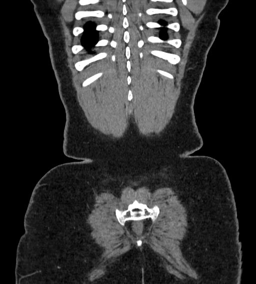 Bilateral ovarian mature cystic teratomas (Radiopaedia 79373-92457 B 106).jpg