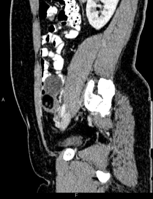 Bilateral ovarian teratoma (Radiopaedia 83131-97503 D 47).jpg