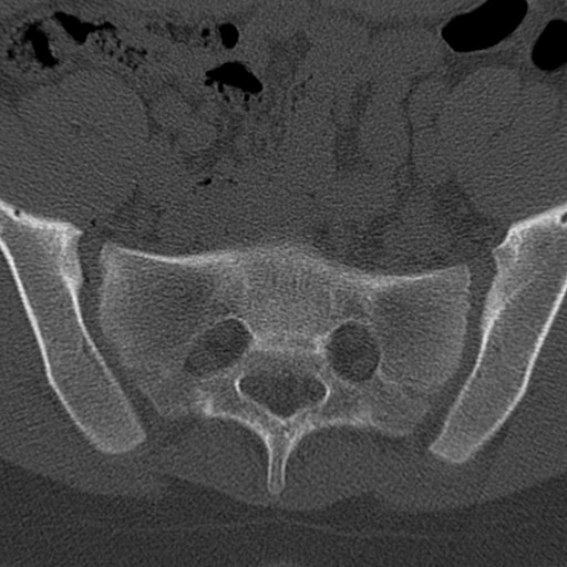 Bilateral pars defect (Radiopaedia 26691-26846 Axial bone window 91).jpg