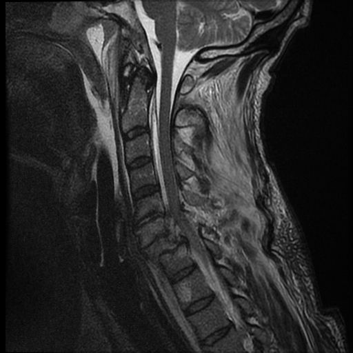 File:Bilateral perched facets with cord injury (Radiopaedia 45587-49714 Sagittal T2 9).jpg