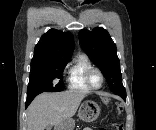 Bilateral pulmonary AVM (Radiopaedia 83134-97505 C 21).jpg