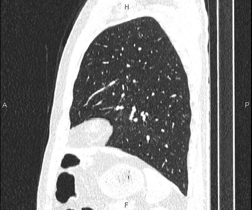 Bilateral pulmonary AVM (Radiopaedia 83134-97505 Sagittal lung window 84).jpg