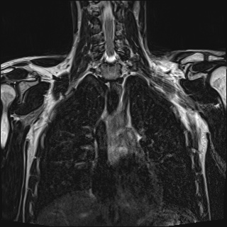 Bilateral spinoglenoid notch ganglion cysts (Radiopaedia 29577-30082 Coronal T2 60).jpg