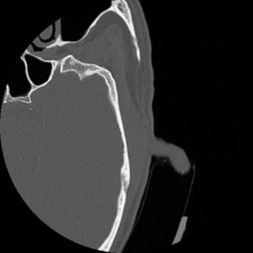 Bilateral temporal bone fractures (Radiopaedia 29482-29970 D 128).jpg