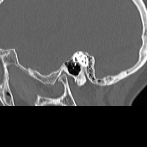 Bilateral tympanoplasty (Radiopaedia 16947-16664 Sagittal bone window 25).jpg