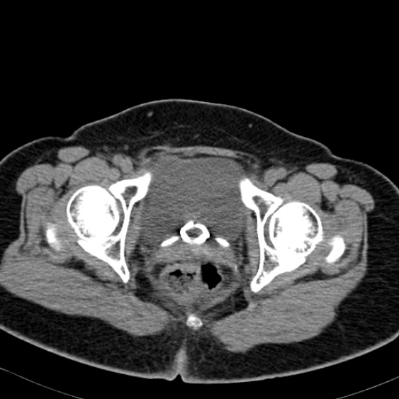 Bilateral ureteric stents (Radiopaedia 48795-53825 Axial non-contrast 65).jpg
