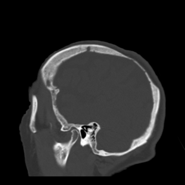 Biparietal osteodystrophy (Radiopaedia 46109-50463 Sagittal bone window 23).jpg