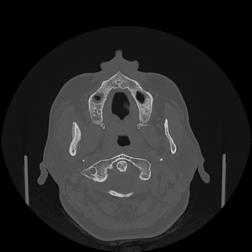 File:Bisphosphonate-related osteonecrosis of the jaw (Radiopaedia 71324-81642 Axial bone window 113).jpg