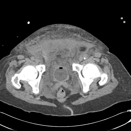 Bladder rupture post renal biopsy (Radiopaedia 30863-31572 Axial non-contrast 83).jpg