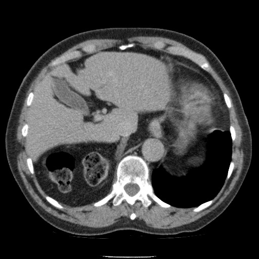 Bladder tumor detected on trauma CT (Radiopaedia 51809-57609 C 30).jpg