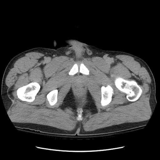 File:Blunt abdominal trauma with solid organ and musculoskelatal injury with active extravasation (Radiopaedia 68364-77895 Axial C+ delayed 141).jpg