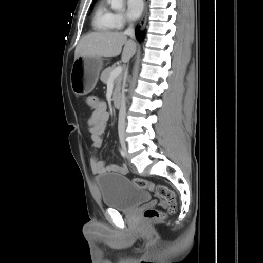 File:Blunt abdominal trauma with solid organ and musculoskelatal injury with active extravasation (Radiopaedia 68364-77895 C 72).jpg