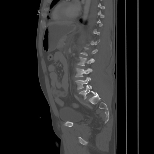 File:Blunt abdominal trauma with solid organ and musculoskelatal injury with active extravasation (Radiopaedia 68364-77895 Sagittal bone window 62).jpg