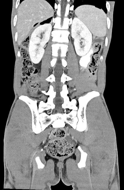 Blunt injury to the small bowel (Radiopaedia 74953-85987 B 71).jpg